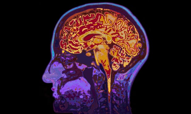An MRI image of the brain.