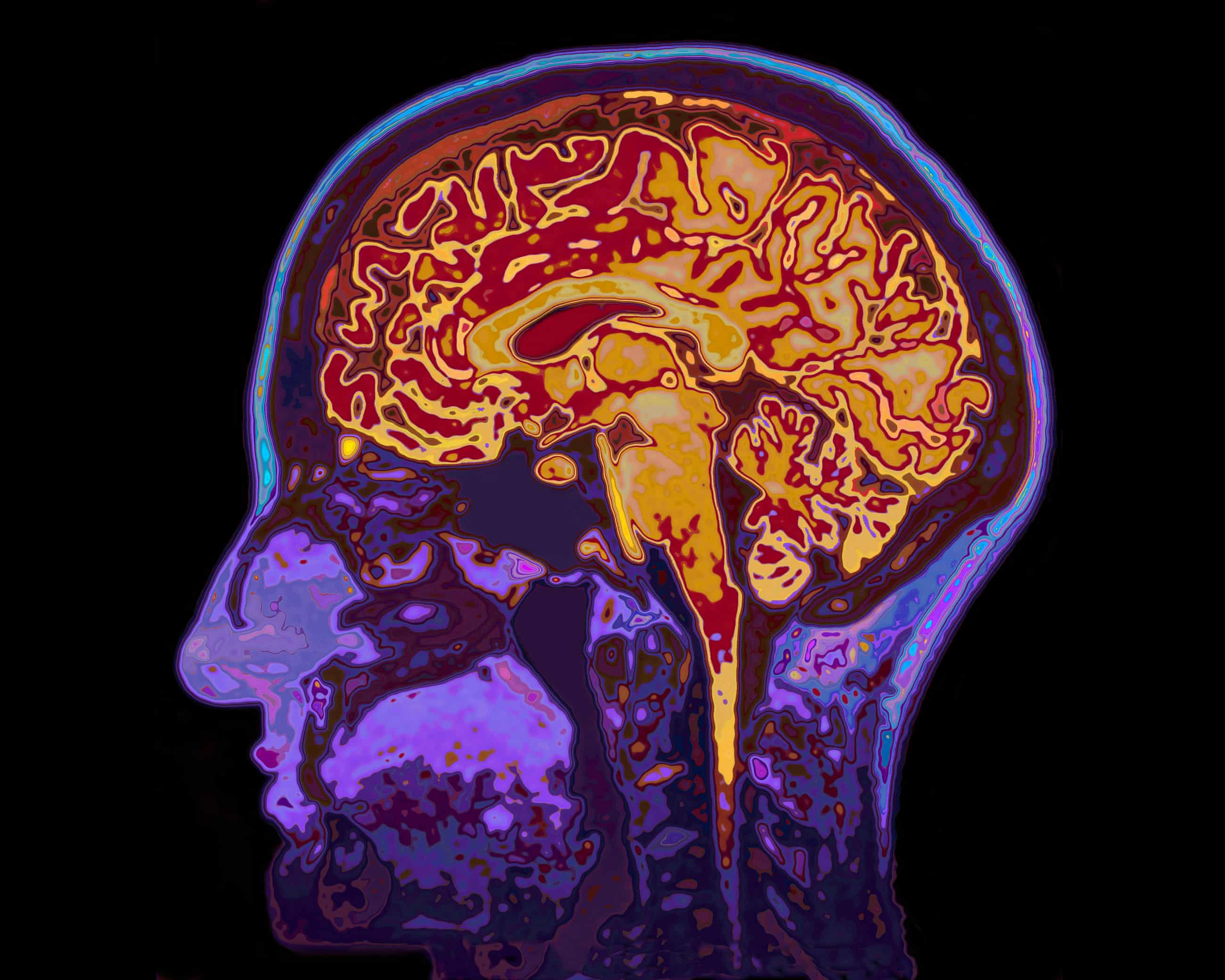 Scans shed light on changes in brain when we zone out while tired