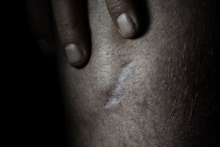 Close up of a man pointing to a scar on his skin