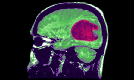 A brain scan of a glioblastoma tumour.