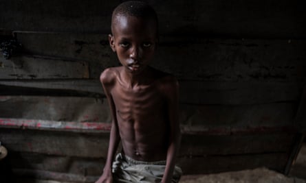 A child with pneumonia in Luanda