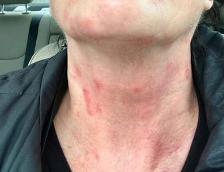 Delta crew members reported rashes.