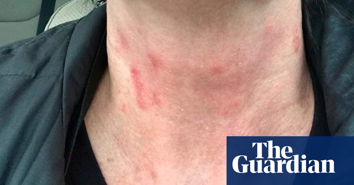 Chemical Burns Delta Flight Attendants Say New Uniforms Cause