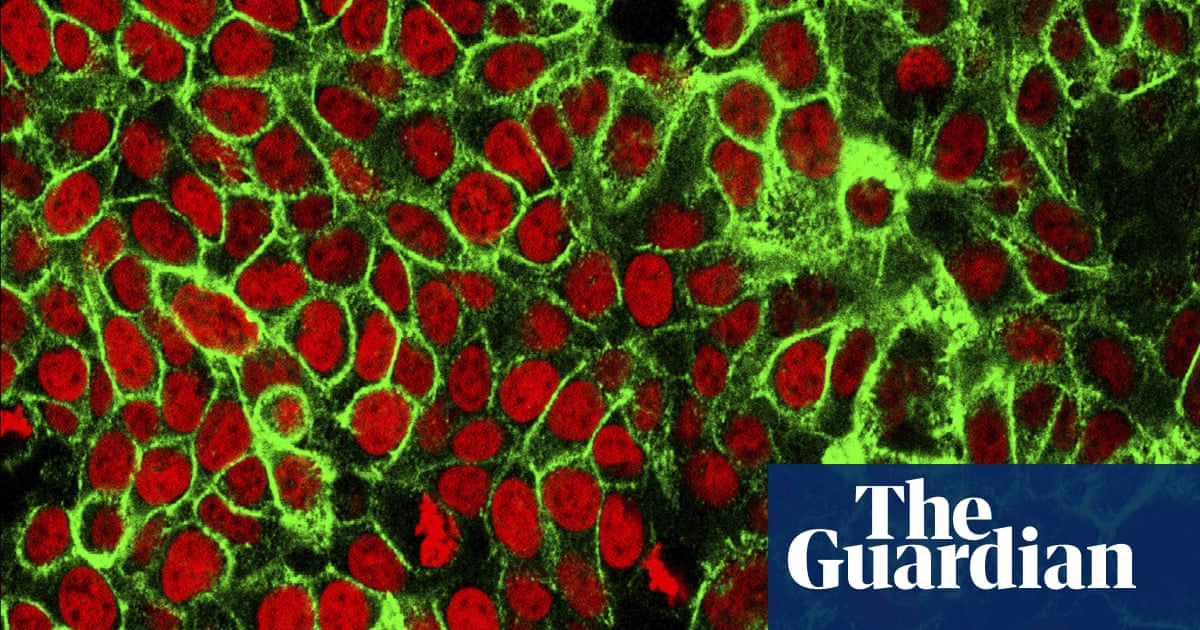 Rectal cancer: researchers hail ‘breakthrough’ experimental treatment