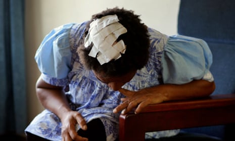 A victim of domestic violence shows her head wound patched up with tape in a women’s shelter in Port Moresby.
