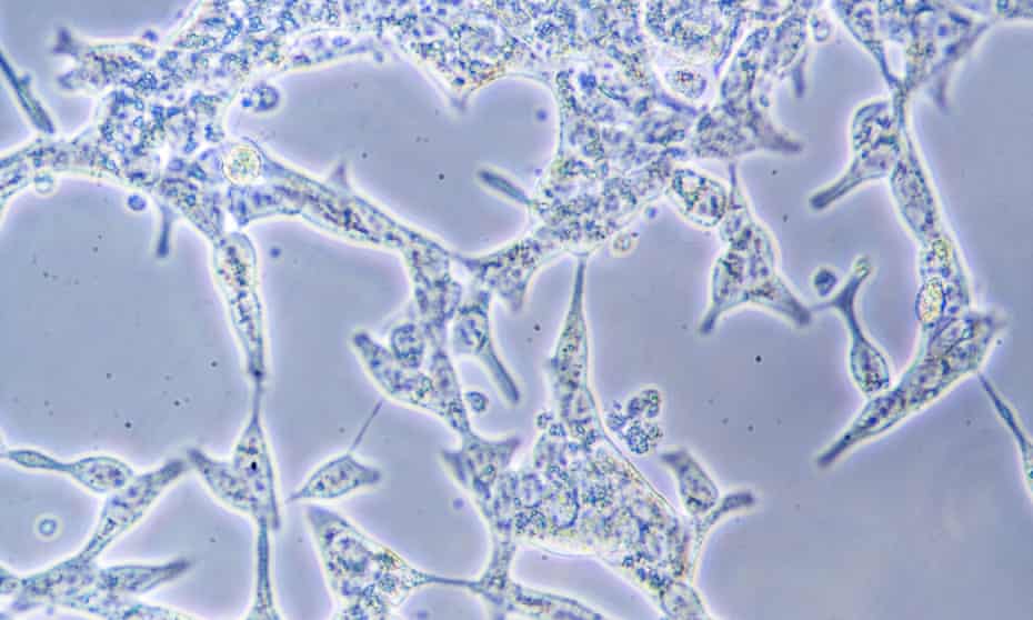 Microscope view of prostate cancer cells in tissue culture. Scientists have produced a map of genetic mutations linked to the disease. 