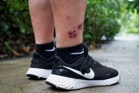 Bite wounds on leg