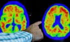Are cancer survivors less likely to develop Alzheimer’s?