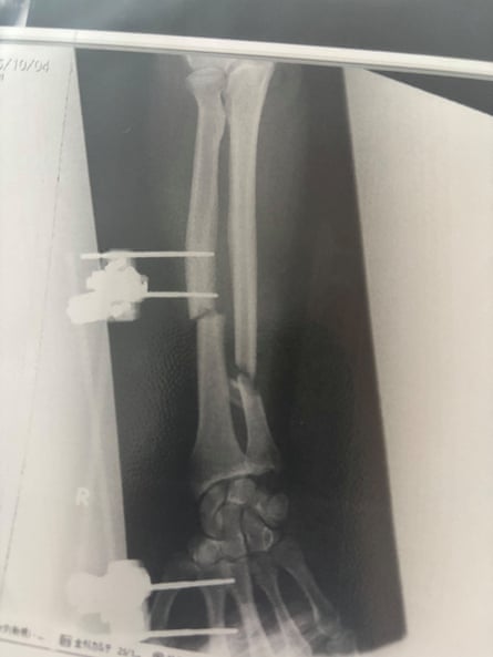 A bear shattered Billy Halloran’s arm with one bite during the brief but traumatic attack