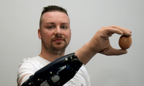 Milorad Marinkovic holds an egg with his bionic hand