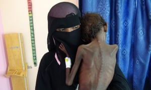 Yemeni mother Nadia Nahari holding her five-year-old son Abdelrahman Manhash, who is suffering from severe malnutrition and weighing 5 kilograms, at a treatment clinic in the Khokha district in the western province of Hodeidah