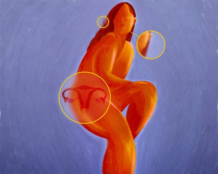 PCOS illustration showing. figure of red woman against a mauve background and a diagram of ovaries