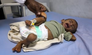 A malnourished Yemeni child receives treatment at a hospital.