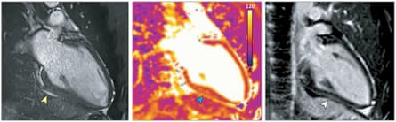 A magnetic resonance imaging (MRI) scan of the hearts of athletes recovering from Covid-19.