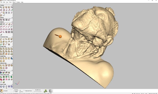 A neck dissection seen in Virtual Cadaver 3D.