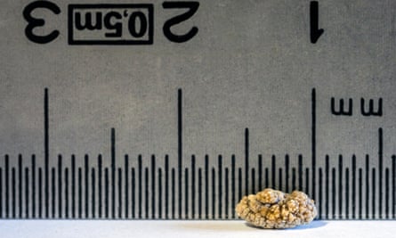 A 6mm kidney stone, the maximum size that can be expelled by a patient.
