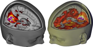 LSD brain scan