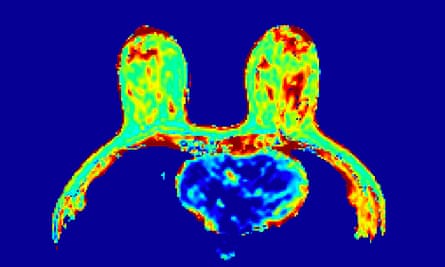 A scan of healthy breasts, scanned using multiparametric MRI.