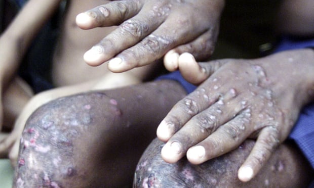 A Bangladeshi boy shows his arsenic-affected hands and feet in Koyla, a village southwest of Dhaka.