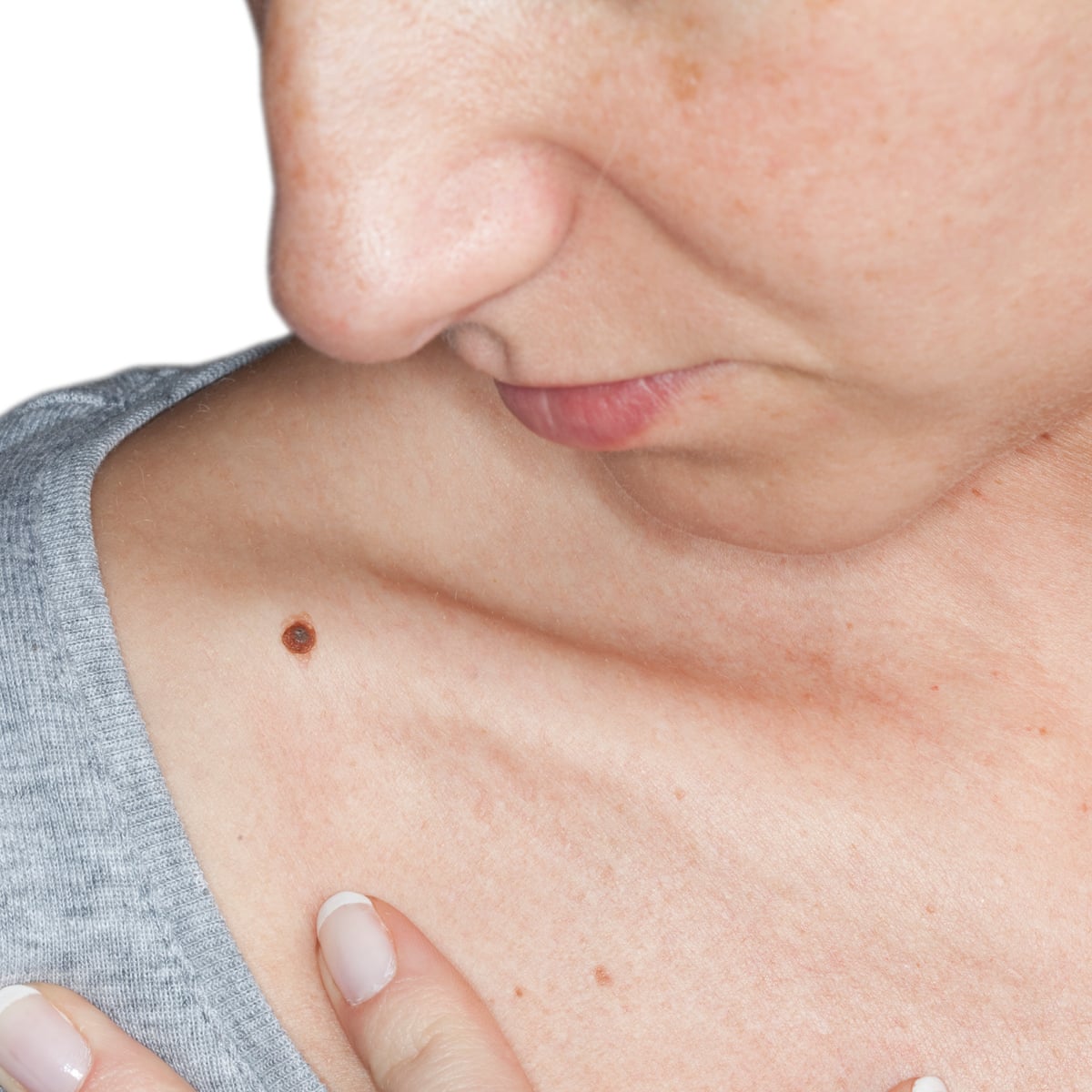Skin Tags During Pregnancy