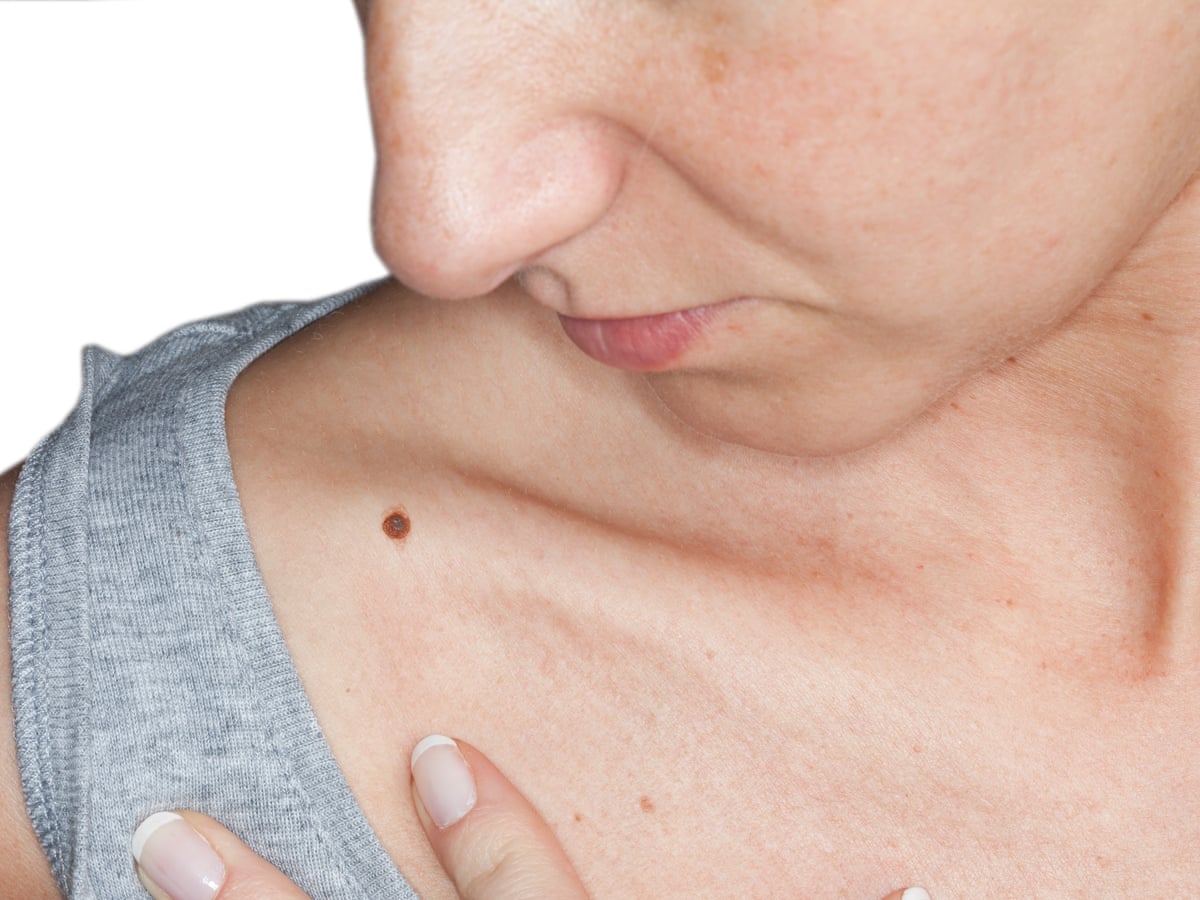 Everything You Ever Wanted To Know About Moles But Were Too Busy On The Sunbed To Ask Health Wellbeing The Guardian