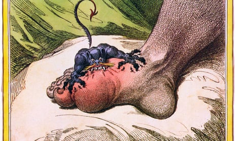 The Gout - a 1799 cartoon by James Gillray depicting the pain caused by the disease