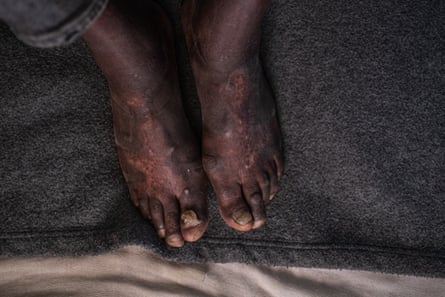 A black man’s feet covered in red blotchy scars
