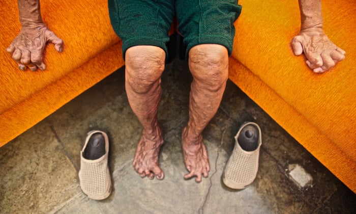 Tackling Leprosy In The Philippines In Pictures Healthcare Professionals Network The Guardian