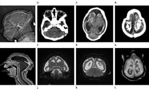 MRI images obtained in the case of an 18-year-old woman with confirmed Zika virus infection in Brazil.