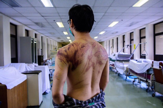 Calvin So, 23, a resident of the rural town of Yuen Long, shows his wounds and bruises after he was assaulted on his way home by gangs of men who set upon demonstrators.