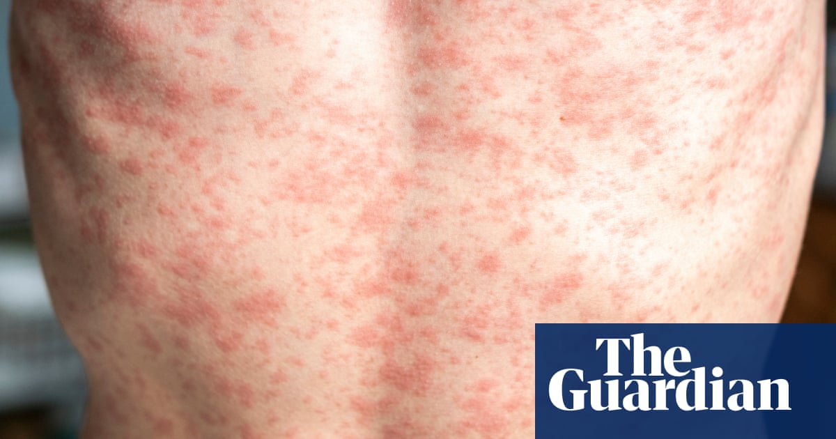 Measles outbreak: how contagious is it and what are the symptoms?