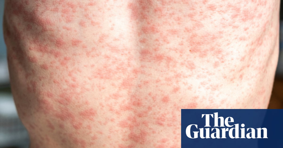 How contagious is measles and what are the symptoms?