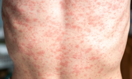A person's body is covered in a rash, measles.