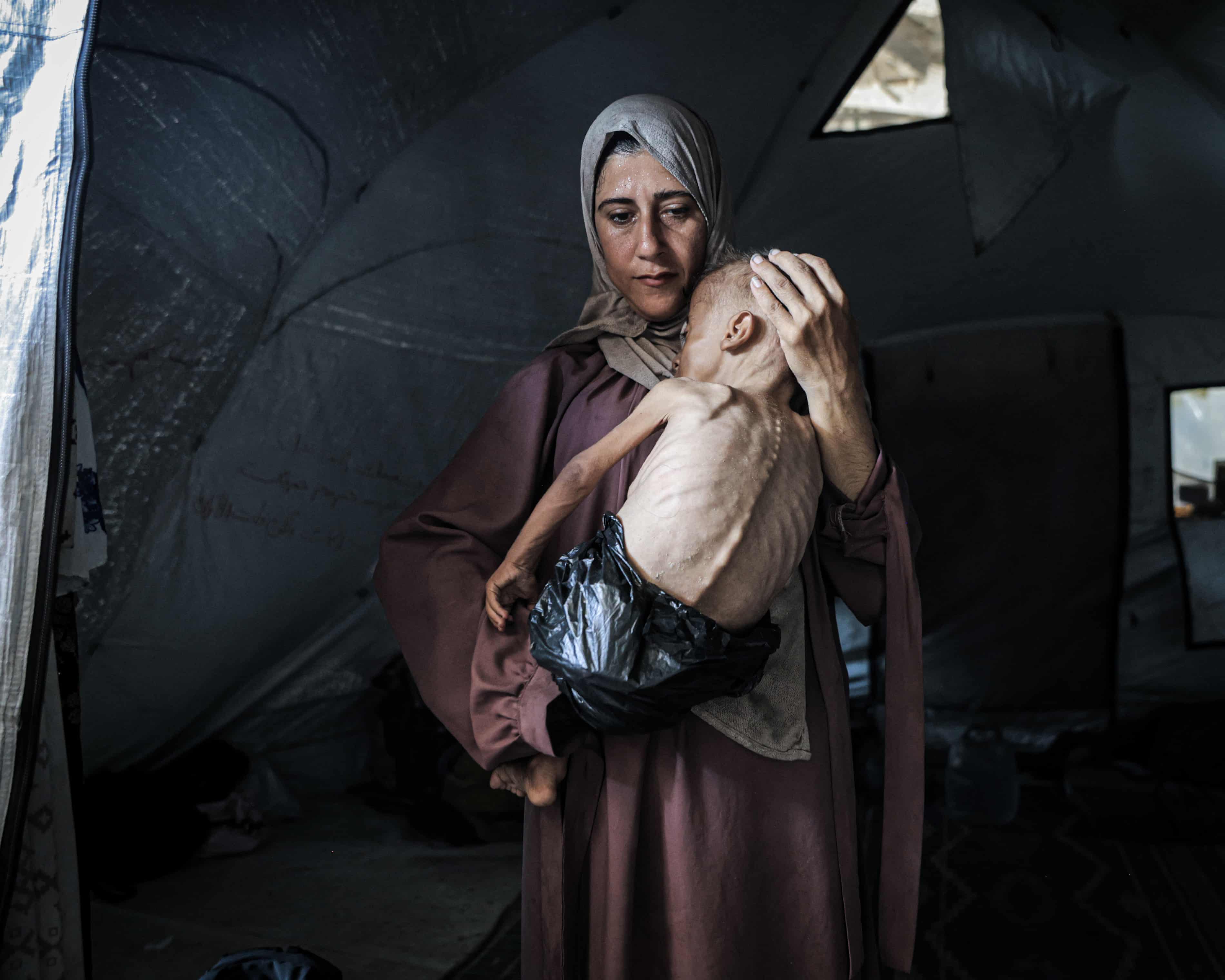 Starving Gaza toddler %28with pre-existing health condition%29 Photo