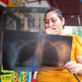 Woman looks with concern at her lung x-ray image