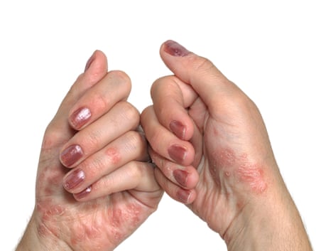 The hands of a woman with psoriasis.