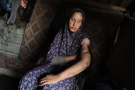 A woman sustaining injuries on her eyes and arms sits in a home