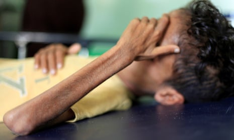 Malnourished Ghazi Ahmad, 10, lies on a bed at a hospital in Taiz, Yemen in October 2018. 