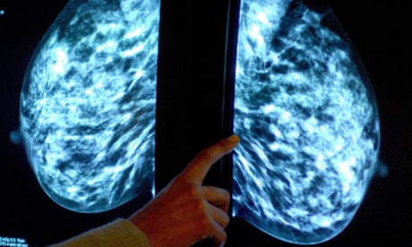 Breast cancer cell growth halted by osteoporosis drug, study shows