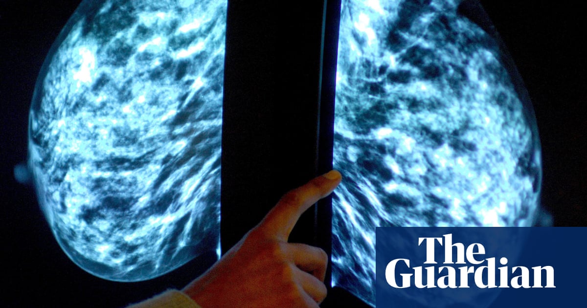 NHS Trials Early Breast Cancer Checks in England