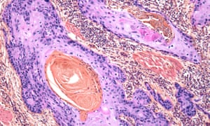 Squamous carcinoma of the skin
