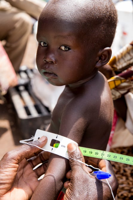 An aid worker measures the arm of a child in South Sudan to assess the presence and severity of malnutrition.