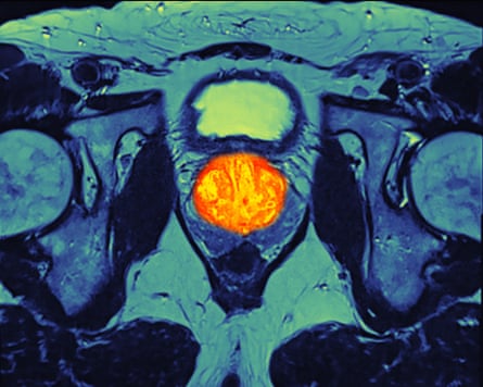 An MRI scan showing a pelvis with prostate cancer.