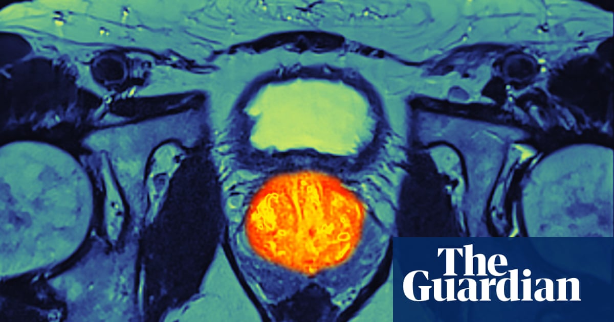 Navigating the Prostate Cancer Screening Debate: A Matter of Life and Death