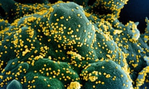 A colourised electron microscope image of a human cell heavily infected with coronavirus