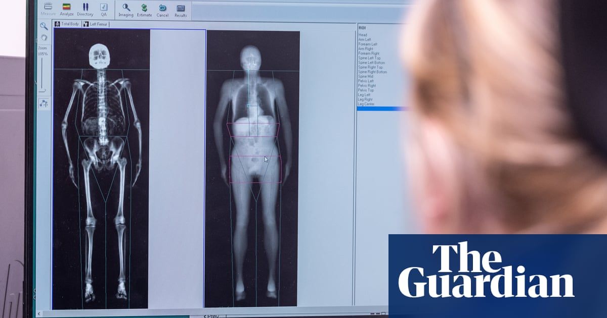 UK Biobank Completes Imaging of 100,000 Volunteers in Largest Body Scan Study