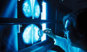 Doctor looking at mammograms
