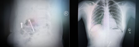 Two X-ray images side by side. On the left is a close up showing two long, white objects; on the right is an image showign the ribs and lungs as well as part of the abdomen, in which three long white pointed objects can clearly be seen.