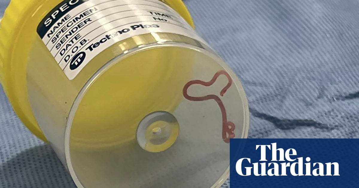 From botflies to eye worms, a brief history of rare parasites in humans - The Guardian