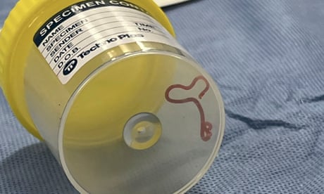 The roundworm removed from the brain of a woman in Canberra, Australia